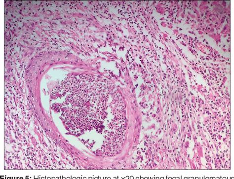 [pdf] Atypical Presentation Of Tuberculosis Semantic Scholar