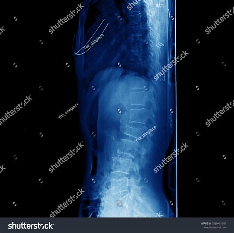 Lateral Projection Xray Thoracolumbar Spine Showing Stock Photo Edit