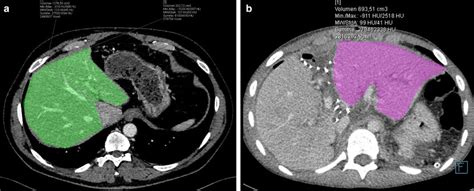 Liver Segments Ct Scan