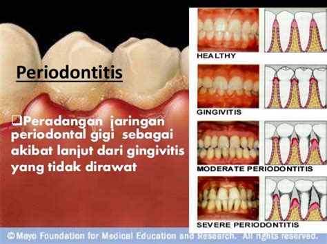 Menggapai Mimpi Penyakit Periodontal