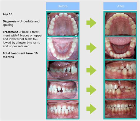 Smile Gallery Saxe Orthodontics