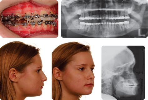 10 Orthognathic Surgery Pocket Dentistry