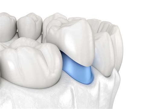 Does a Dental Crown Protect Your Tooth? - Georgetown Dental Partners ...