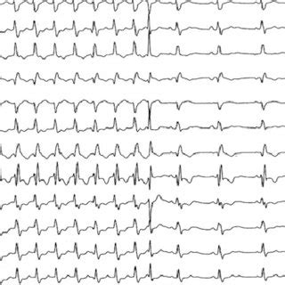 Twelve Lead Ecg Showing A Wide Qrs Complex Tachycardia At A Cycle