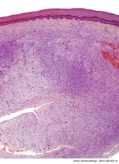 Dermatofibrosarcoma Pathology Outlines