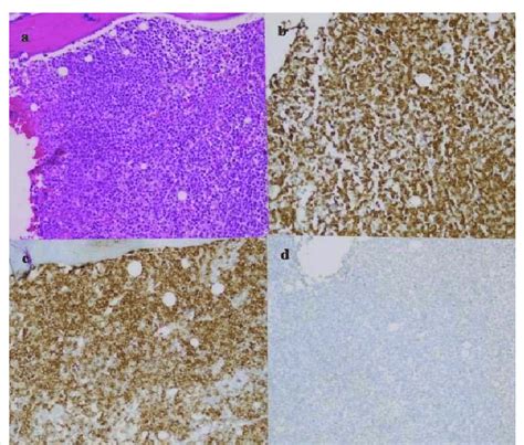 Histology Of Bone Marrow Biopsy A Hematoxylin Eosin Staining