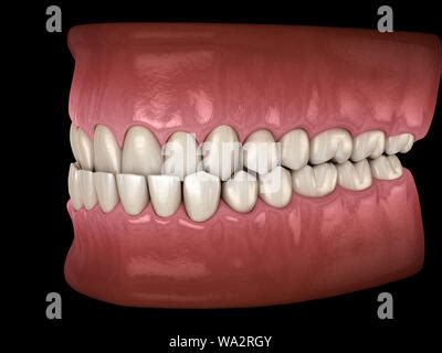 Underbite Dental Occlusion Malocclusion Of Teeth Medically