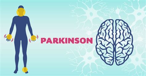 La Enfermedad De Parkinson Secretaría De Salud Gobierno Gobmx