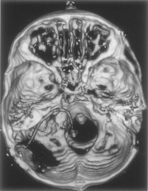 Three Dimensional Ct Scan Reconstruction Of The Skull Base In A Patient