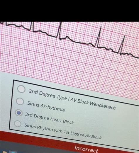 Solved Junctional Tachycardia Supraventricular Tachycardia | Chegg.com