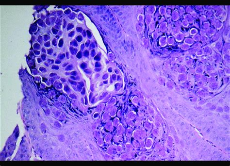 Histopathological Picture Of Molluscum Contagiosum Showing Typical