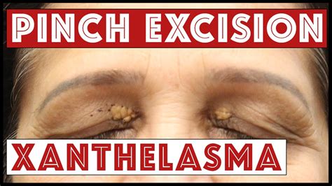 Xanthoma Removal Natural