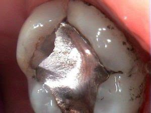 A closer look at amalgam (silver) fillings – Berkshire Dentist