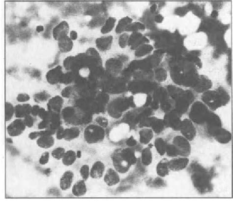 Figure 1 From Four Quadrant Fine Needle Aspiration Cytology For The Detection Of Benign