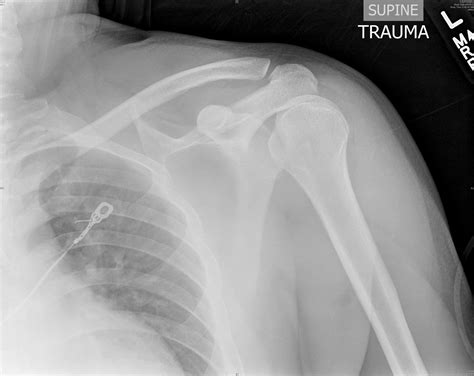 Shoulder Trauma 2016 08 08 Ahc Media Continuing Medical