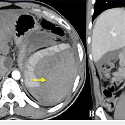 Splenic Hematoma Ultrasound