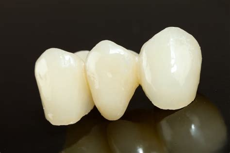 Crowns and Bridges - Channo DDS