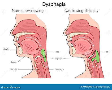 Normaal Vs Dysfagie Slikschema Medisch Stock Illustratie Illustration