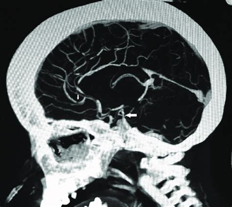 Computerized Tomography Second Scan Cerebral Angiography Of Brain Download Scientific Diagram