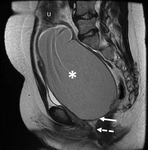 Imaging Of The Vagina Spectrum Of Disease With Emphasis On Mri