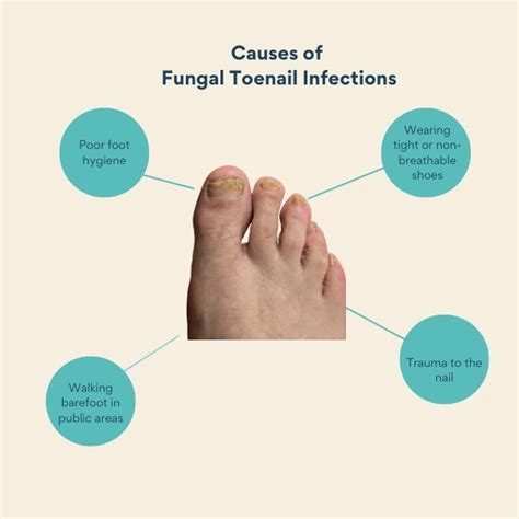 Learn all about fungal toenail infections – SkinQure