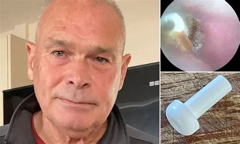 Man Thought He Was Going Deaf Until He Discovered Earbud Lodged In