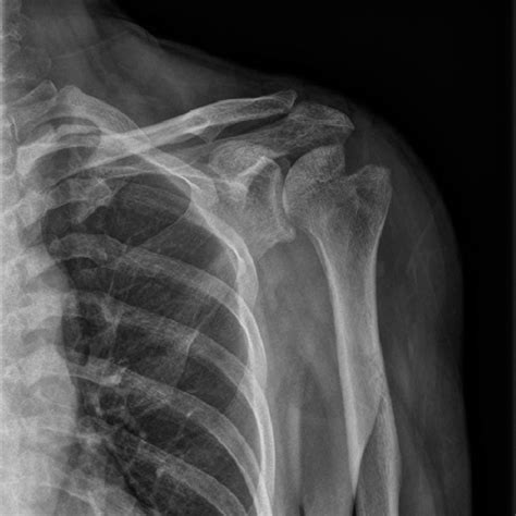 Shoulder Mri Showing Osteomyelitis Of The Greater Tuberosity Of The Download Scientific Diagram