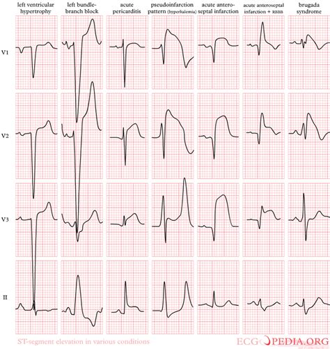 File Pathologic ST Elevation Png ECGpedia