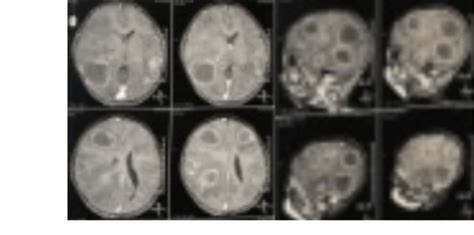 Case Presentation 3 Multiple Brain Abscesses As Detected By Mri Brain Download Scientific