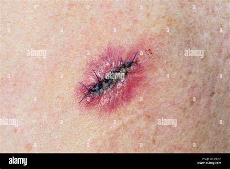 Medical Stitches Stock Photos & Medical Stitches Stock Images - Alamy