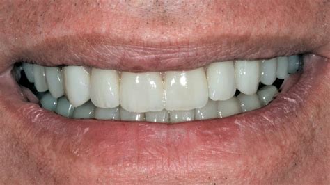 Quanto Tempo Um Dente Demora Para Crescer