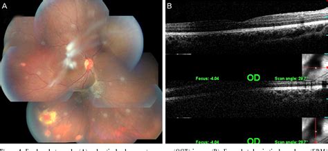 Figure 4 From A Case Report Of Primary Vitrectomy In Multiple Bilateral Retinal Capillary