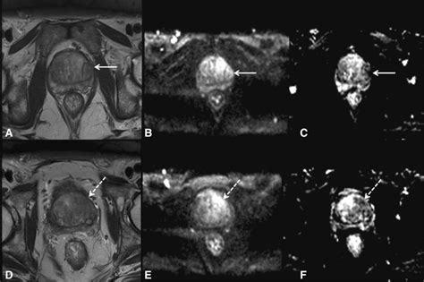 Prostate MRI Based On PI-RADS Version 2: How We Review And, 54% OFF