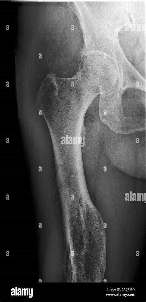 malunited fracture  ray   leg    year  female patient