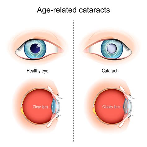 What Is The First Sign Of Cataracts Warning Signs Of Cataracts