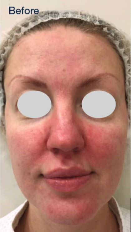 Patient 10342 Ipl Rosacea Before And After Photos Fenton Plastic Surgery Gallery Sterling