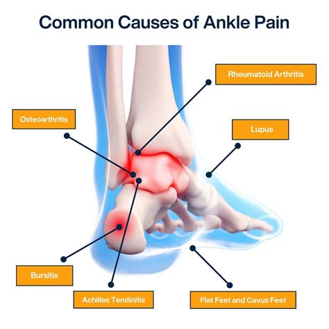 What Can Cause Ankle Pain Without Injury Pain Management Nyc