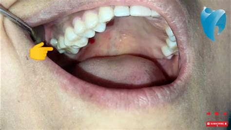 Bucally Erupted Wisdom Tooth Cheek Bite Painful Extraction Of Wisdom Tooth Dr Swostik