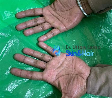 Hyperhidrosis Dr Uttam Lenkas Skin Hair And Laser Clinic