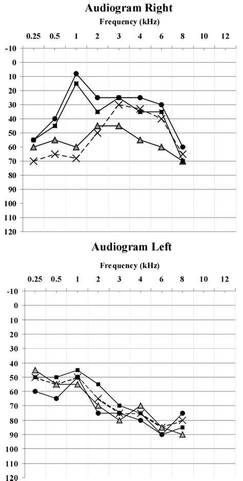 Air Conduction Thresholds Measured At Different Dates Download Scientific Diagram