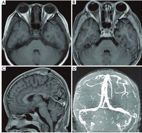 The Brain Mri And Mrv Scanning Images A B The Axial Position