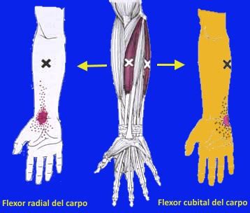 Si Puedes Evidencia Bergant N Dolor Cubital De Mu Eca Revisi N Alcanzar