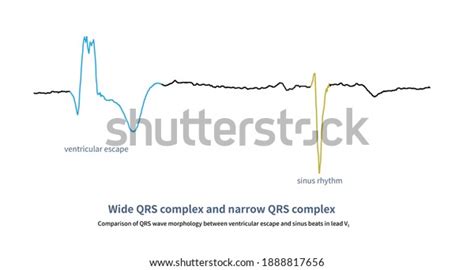 ventricular escape beat royalty  images stock  pictures