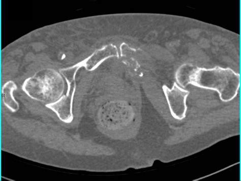 Pubic Ramus Fracture Image Images – FRACTURE