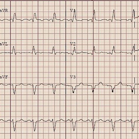 Electrocardiogram Showing Normal Sinus Rhythm With Left Atrial