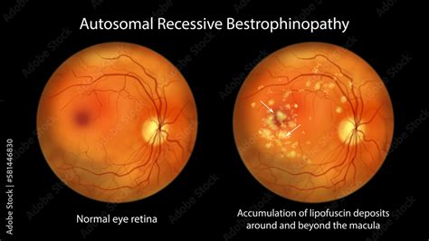 Autosomal Recessive Bestrophinopathy Illustration Showing Normal Eye