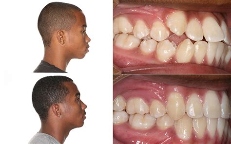 Palate Expander Before And After