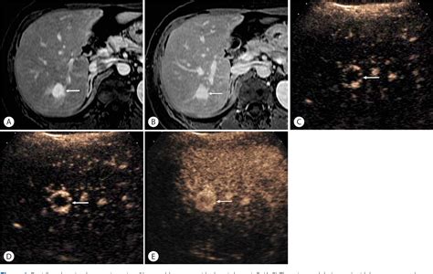 Pdf Contrast Enhanced Ultrasound Ceus Liver Imaging Reporting And