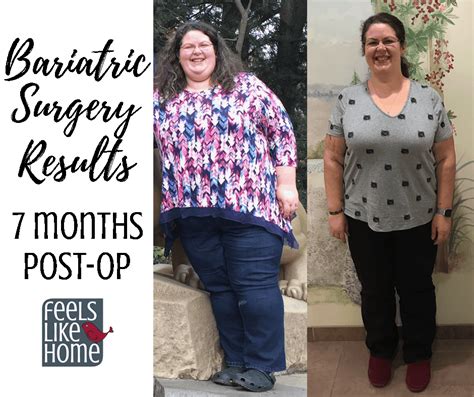 Bariatric Gastric Sleeve Surgery Update And Results Months Post Op