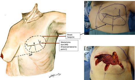 ‘Rosebud’ inset of DIEP flap in delayed breast reconstruction for